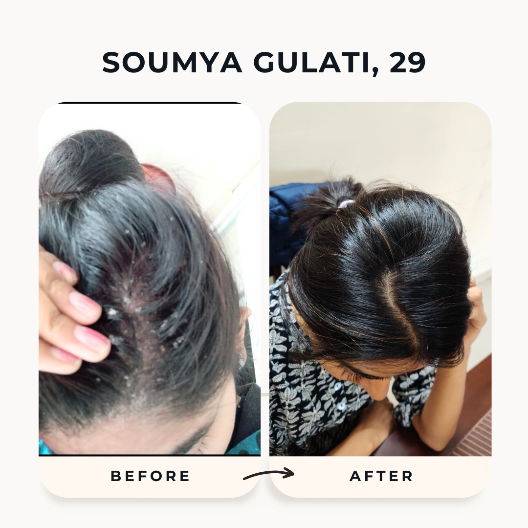 She was suffering from Sebahorric dermititis, Extreme Dandruff