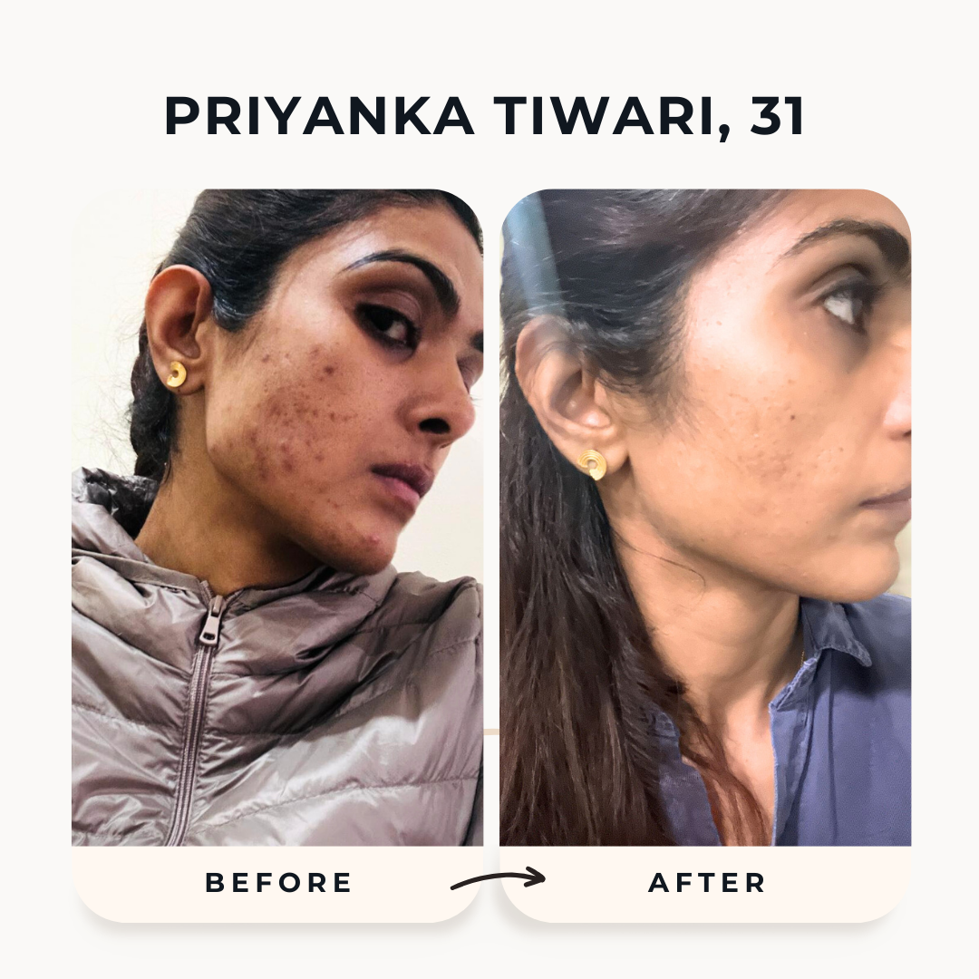 No Dermatologist Treatment helped her Acne, only diet did