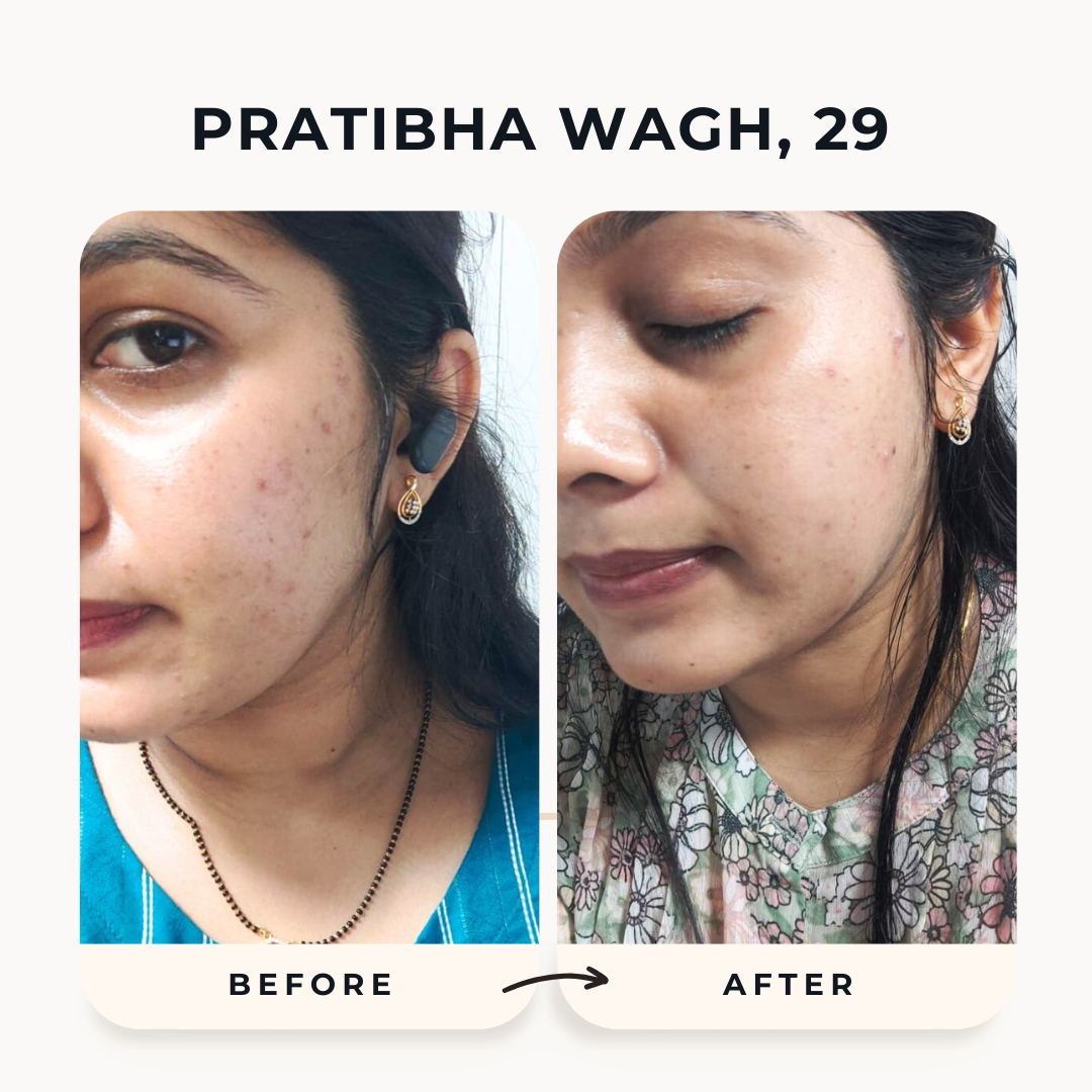 Her acne reduced within 2 Weeks